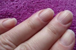 how-to-get-rid-of-longitudinal-stripes-on-the-nails-of-the-hands1